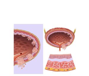 evolución tumor vesical