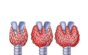 hiperactive thyroid