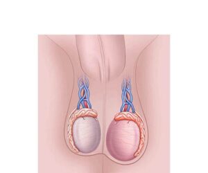 inflamacion de testiculos
