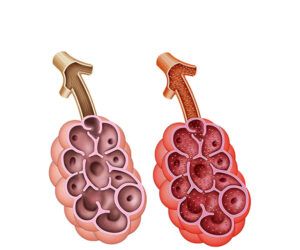 aspergillosis