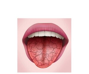 lengua en sindrome de sjögren