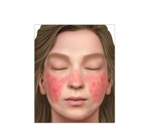 lupus erythematosus