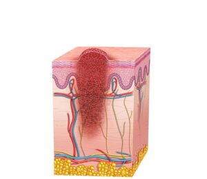 melanoma avanzado