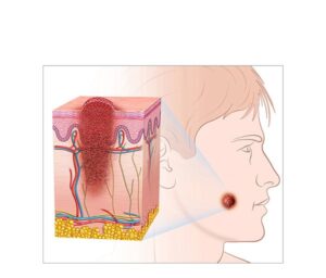 melanoma de cara