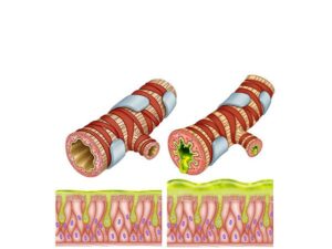 mucuosas epiteliales del los bronqios
