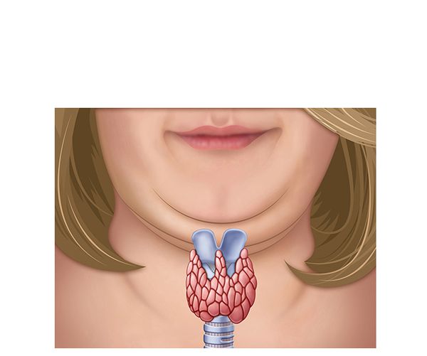 obesidad hipotiroidismo obesidad hipotiroidismo