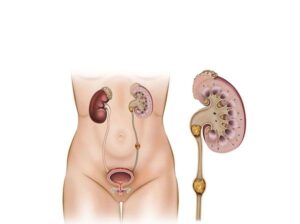 sistema renal femenino con 2 calculos en el riñón