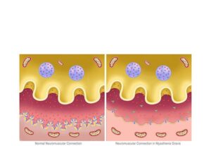 synapse detail myasthenia gravis