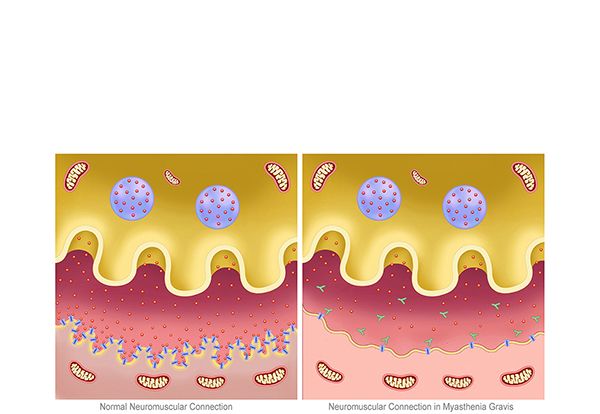 synapse detail myasthenia gravis synapse detail myasthenia gravis