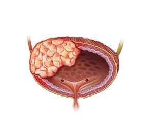 tumor cancerigeno avanzado vesical