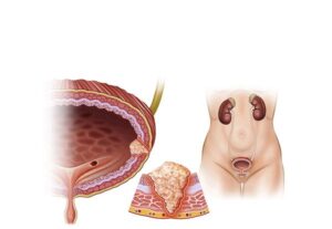 tumor cancerigeno de vejiga