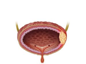 tumor cancerigeno vesical