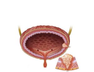 tumor de vejiga