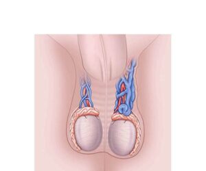 varicocele de testiculos