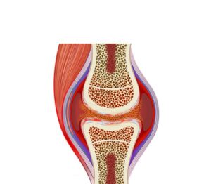 artritis inflamación sinovial